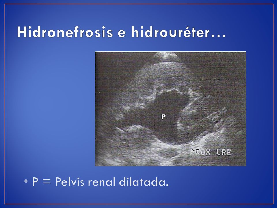 pelvis renal dilatada en adultos pelvis renal dilatada en adultos